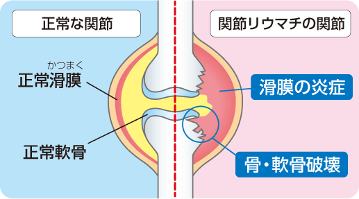 図：関節リウマチの関節の変化